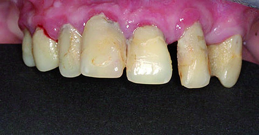 Η κατάσταση των δοντιών και των ούλων της άνω γνάθου