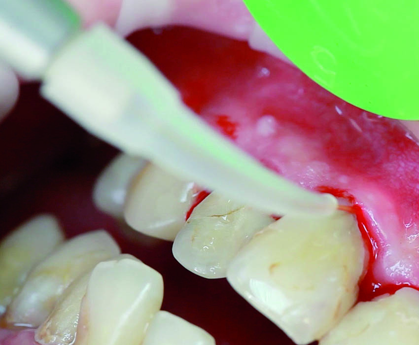 Αποστείρωση και απολύμανση των περιοδοντικών θυλάκων