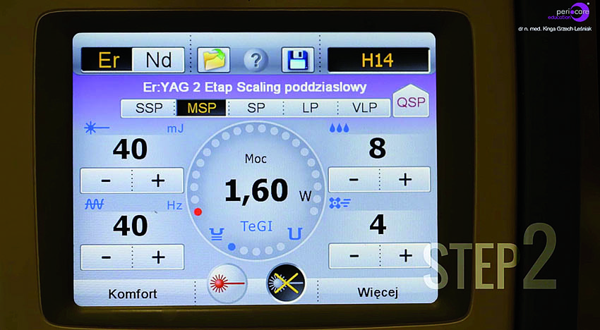 Αφαίρεση της υποουλικής τρυγίας