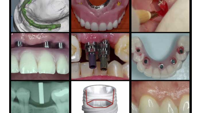 A-Z in Restorative Implant Dentistry Series (16 Lecture Certificate Series)