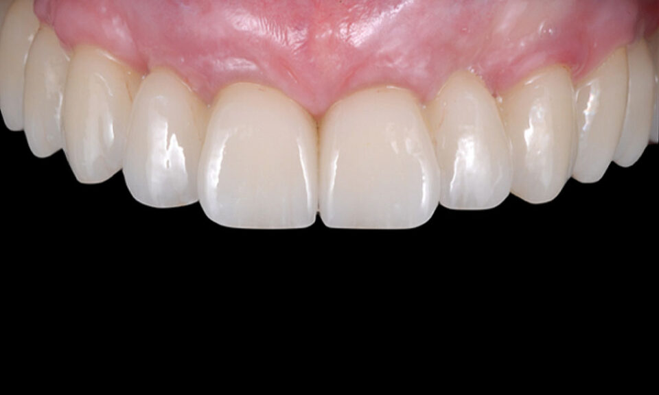 Edentulous Implant Solutions - From Patient to Treatment to Final
