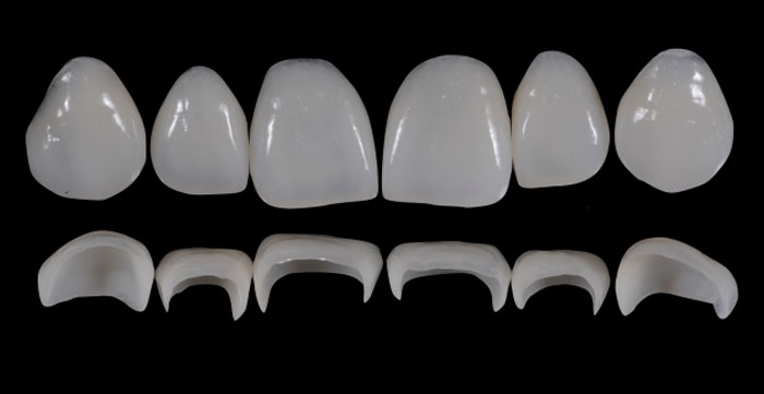 Prosthetic Rehabilitation on Natural Teeth - Predictable, Esthetic and Systematic Steps