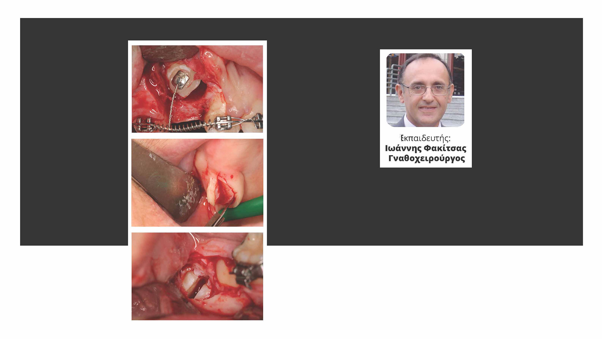Διαχείριση Περιστατικών Στοματικής Χειρουργικής στην Καθημερινή Κλινική Οδοντιατρική Πράξη