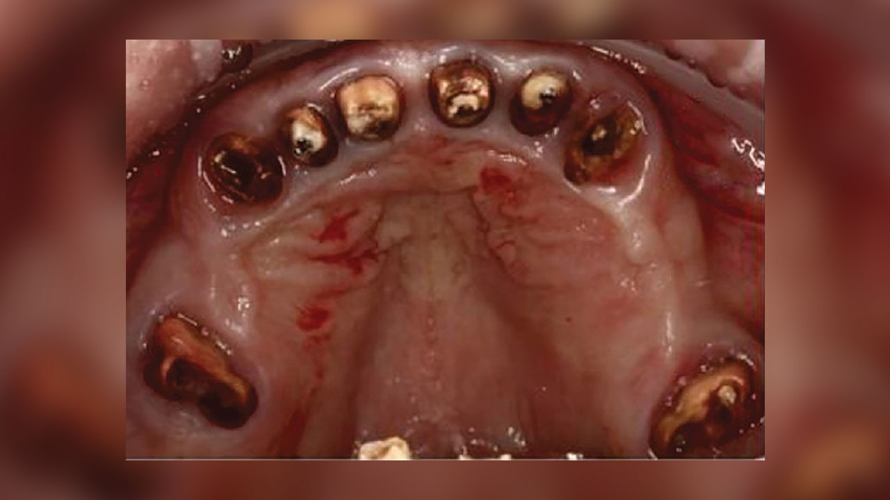 Κοχλιούμενη επιεμφυτευματική ολική αποκατάσταση στόματος με διαβλεννογόνια στηρίγματα multiunit χρησιμοποιώντας εικονική κατευθυνόμενη χειρουργική και πρωτόκολλο ψηφιακής προσθετικής