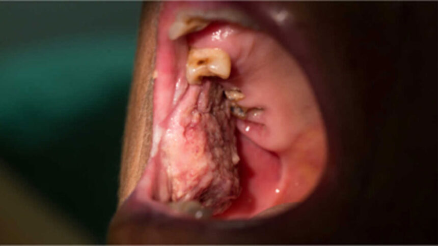 Οι καρκίνοι του στόματος κινδυνέουν να μην ανιχνευτούν κατά τη διάρκεια της COVID-19 κρίσης
