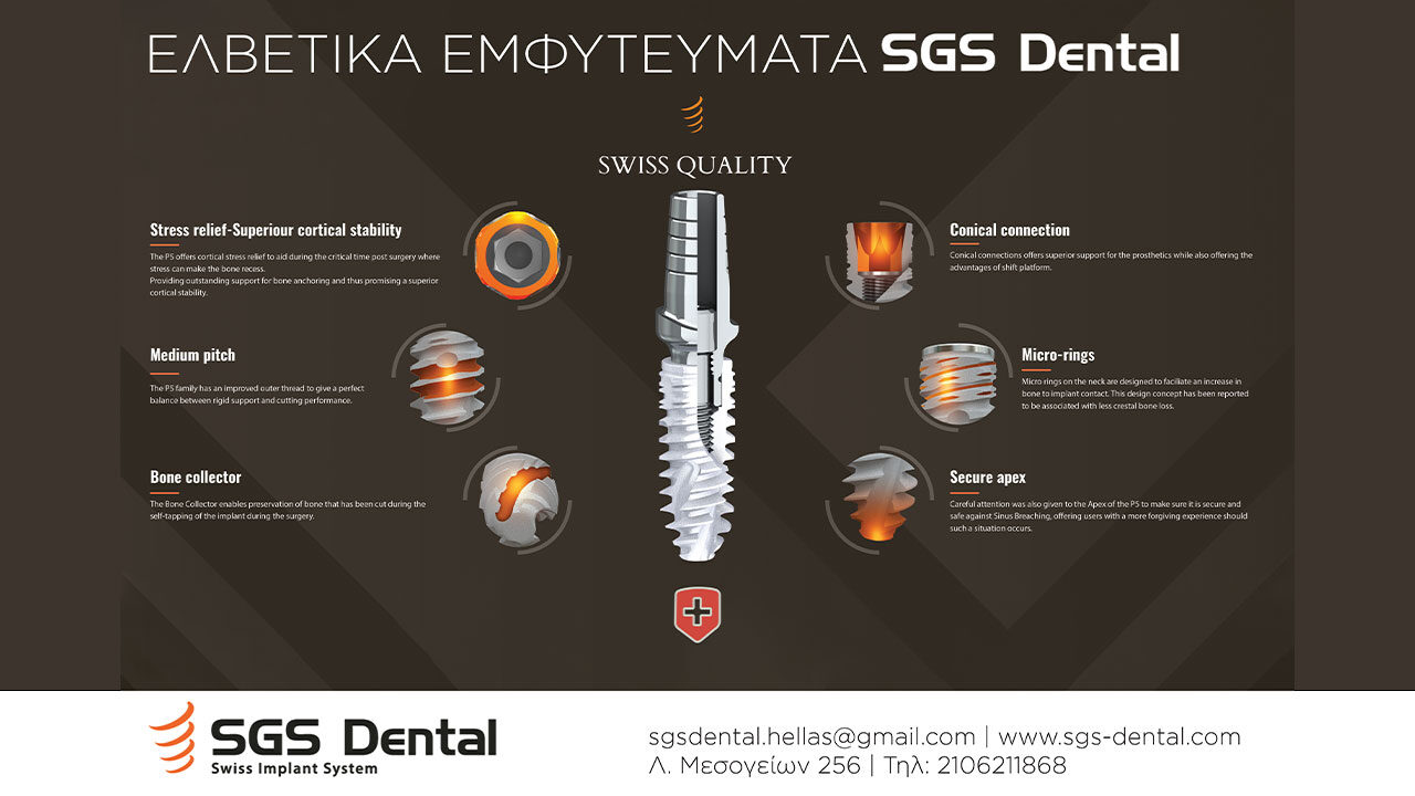 SGS Dental εμφυτεύματα: Τέλεια βιοσυμβατότητα, εγγύηση εφ' όρου ζωής