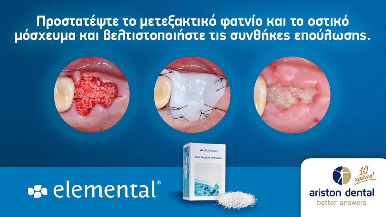 Εlemental - Προστατέψτε το μετεξακτικό φατνίο και το οστικό μόσχευμα και βελτιστοποιήστε τις συνθήκες επούλωσης.