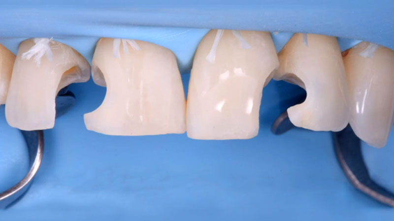 Direct Bonding Restorations - Minimal Invasive Treatment of the Anterior and Posterior Damaged Dentition using Direct Bonded Restorations