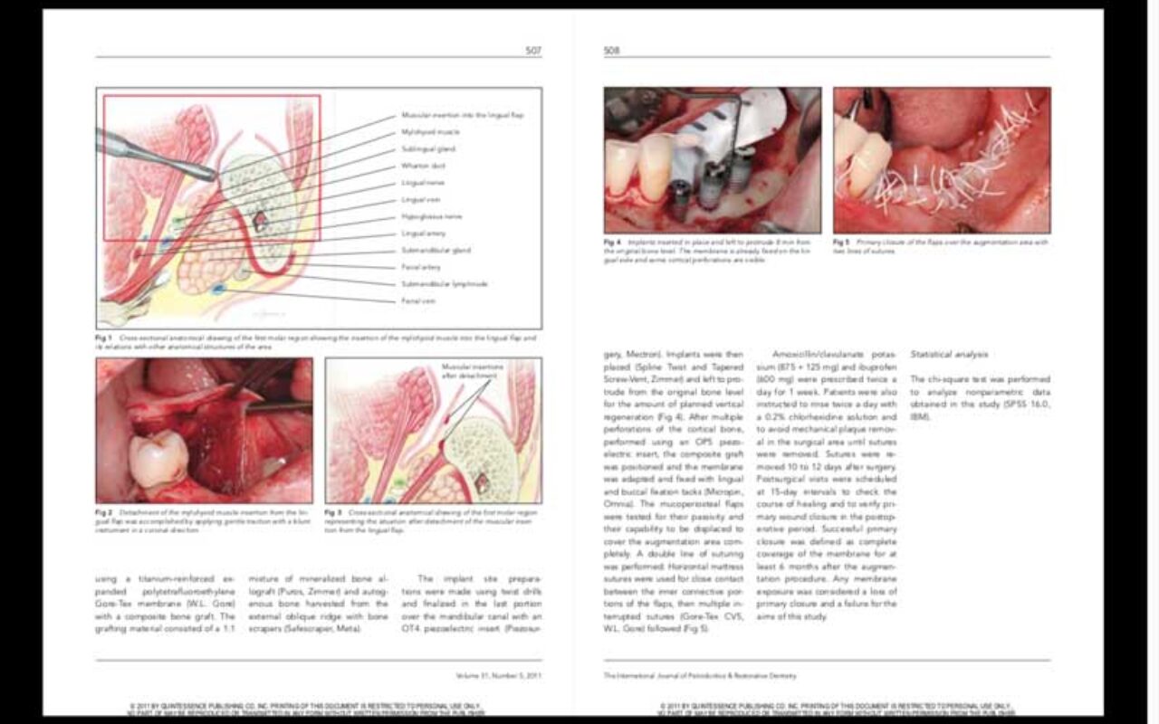 Management of a Coronally Advanced Lingual Flap in Regenerative Osseous Surgery: A Case Series Introducing a Novel Technique
