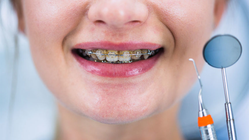 Tα σιδεράκια δεν φέρνουν πάντα την ευτυχία