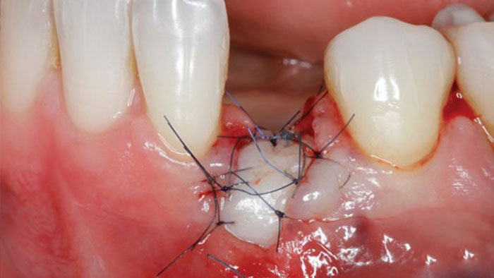 Soft Tissue Management around Natural Teeth and Dental Implants - Fundamentals, evidence based and surgical innovations