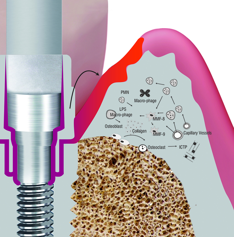 Χωρίς τη χρήση SilverPlug®