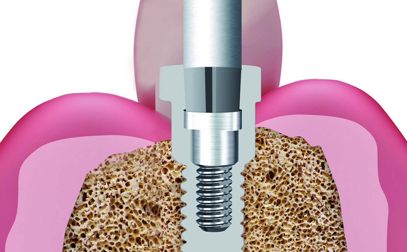 Με τη χρήση SilverPlug®